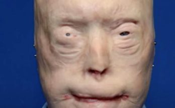 Firefighter has face transplant after third-degree burns & survives against all odds – see him now, 7 years later