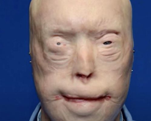 Firefighter has face transplant after third-degree burns & survives against all odds – see him now, 7 years later